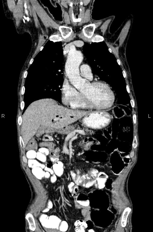 Ampullary adenocarcinoma (Radiopaedia 86093-102033 D 19).jpg
