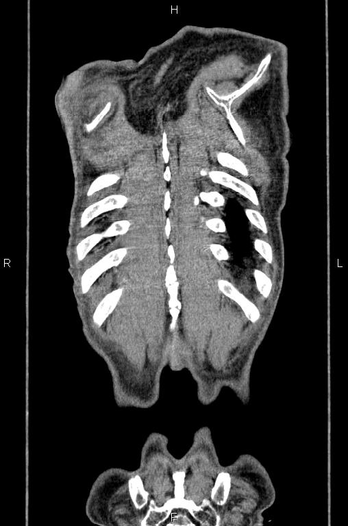 Ampullary adenocarcinoma (Radiopaedia 86093-102033 D 60).jpg