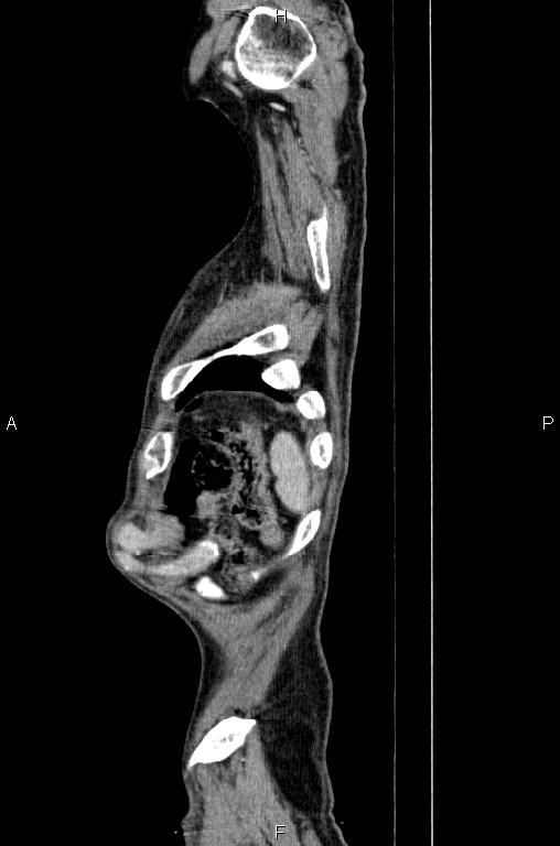 Ampullary adenocarcinoma (Radiopaedia 86093-102033 E 90).jpg