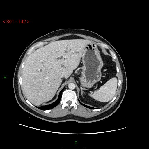 File:Ampullary carcinoma (Radiopaedia 56396-63056 C 22).jpg