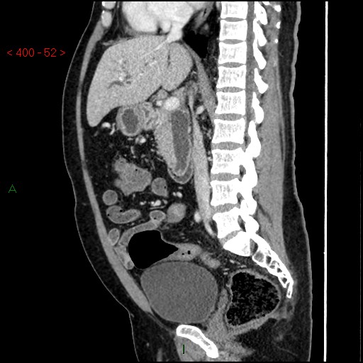 Ampullary carcinoma (Radiopaedia 56396-63056 D 51).jpg