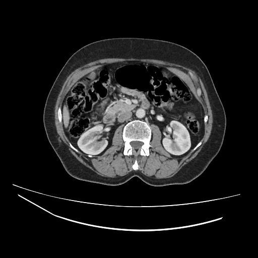 File:Ampullary tumor (Radiopaedia 60333-67998 A 34).jpg