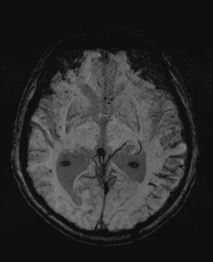 File:Amyloid angiopathy with inflammation (Radiopaedia 30360-31002 Axial SWI MIP 25).jpg