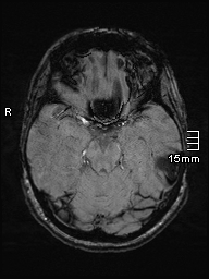 Amyotrophic lateral sclerosis (Radiopaedia 70821-81017 Axial SWI 16).jpg