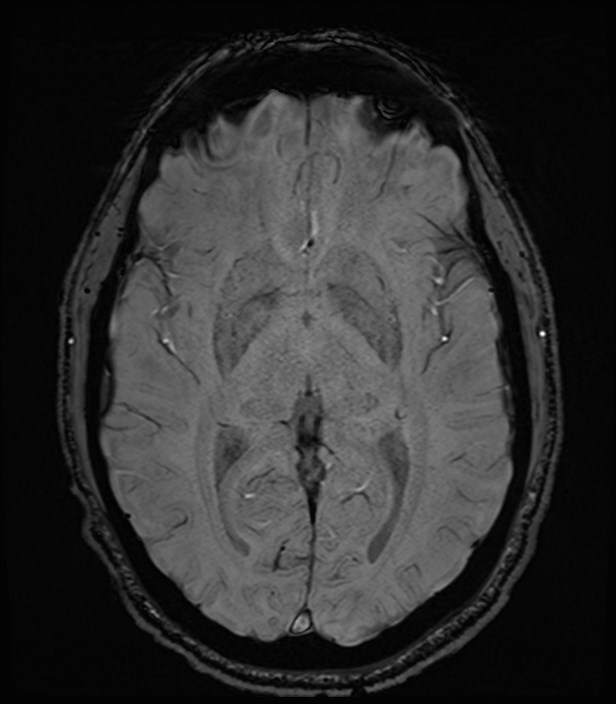 Amyotrophic lateral sclerosis (Radiopaedia 87352-103658 Axial SWI 27).jpg