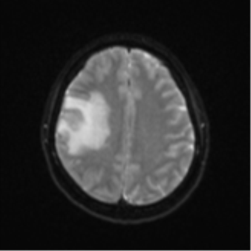 Anaplastic astroblastoma (Radiopaedia 55666-62194 Axial DWI 20).png