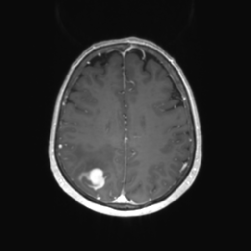 File:Anaplastic astrocytoma (Radiopaedia 86943-103160 Axial T1 C+ 51).png