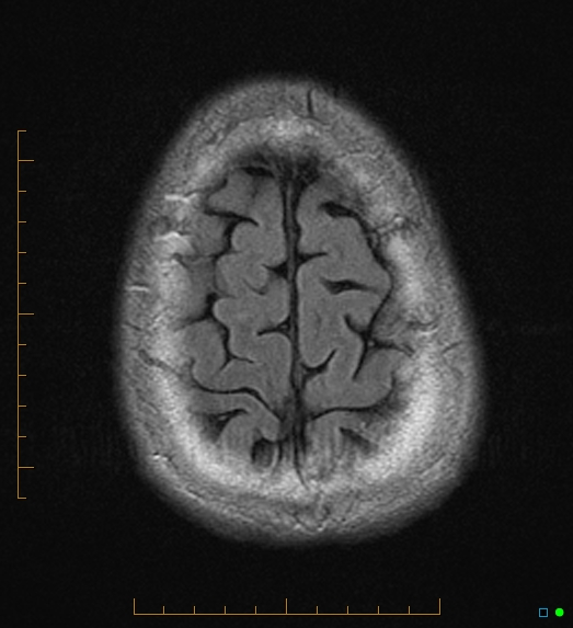 File:Anaplastic astrocytoma (WHO grade III) of the septum pellucidum (Radiopaedia 39365-41633 Axial FLAIR 20).jpg