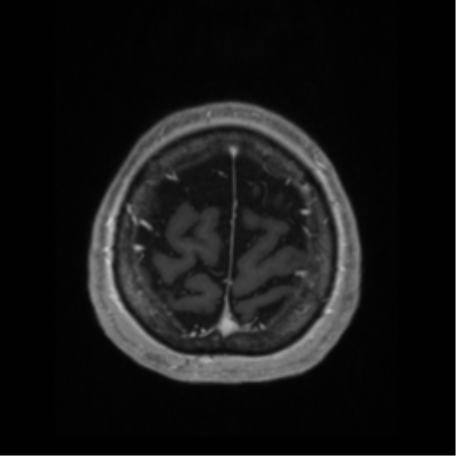 Anaplastic astrocytoma IDH wild-type (pseudoprogression) (Radiopaedia 42209-45276 Axial T1 C+ 130).png