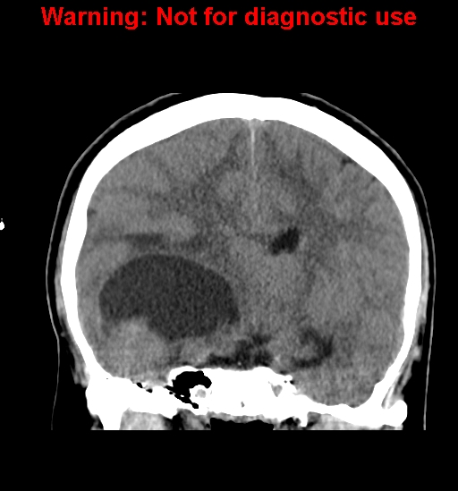 File:Anaplastic ganglioglioma (Radiopaedia 44921-48815 Coronal non-contrast 20).jpg