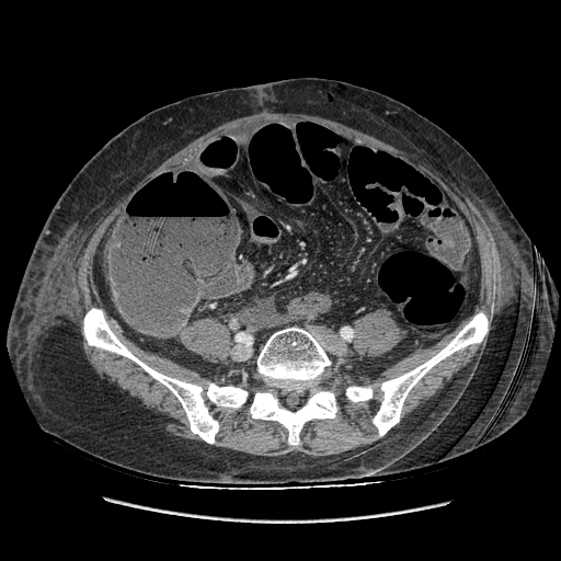 Anastomosis leak at ileostomy closure site (Radiopaedia 82138-96184 B 153).jpg