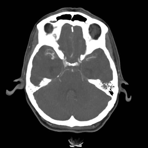 Aneursym related subarachnoid hemorrhage with hydrocephalus (Radiopaedia 45105-49084 A 19).jpg
