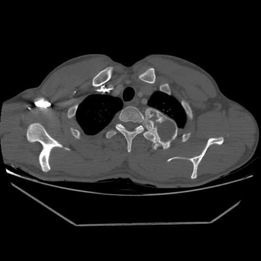 File:Aneurysmal bone cyst - rib (Radiopaedia 82167-96220 Axial bone window 60).jpg
