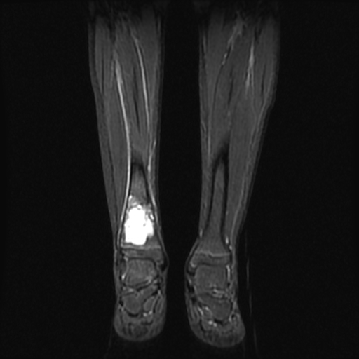 File:Aneurysmal bone cyst - tibia (Radiopaedia 22343-22367 Coronal STIR 9).jpg