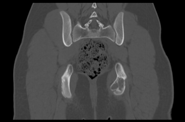 File:Aneurysmal bone cyst of ischium (Radiopaedia 25957-26094 Coronal bone window 33).png