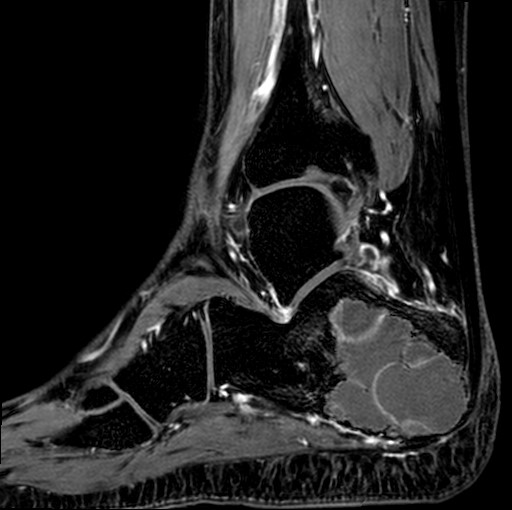 File:Aneurysmal bone cyst of the calcaneus (Radiopaedia 60669-68420 F 13).jpg