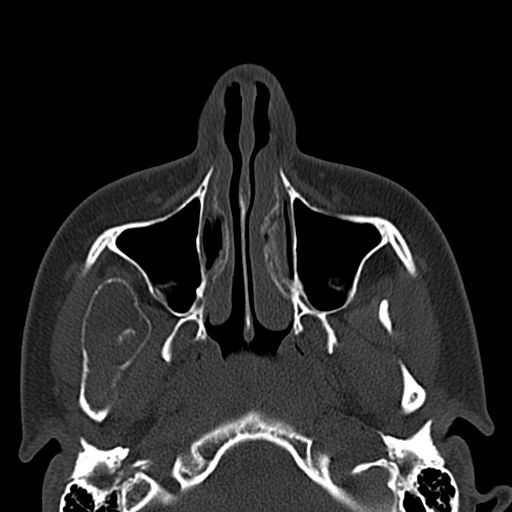 Aneurysmal bone cyst of the mandible (Radiopaedia 43280-46601 Axial bone window 66).jpg