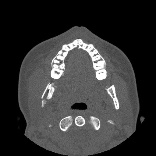 Aneurysmal bone cyst of the mandible (Radiopaedia 43280-46823 Axial bone window 83).jpg