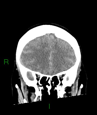 Aneurysmal subarachnoid hemorrhage with intra-axial extension (Radiopaedia 84371-99699 Coronal non-contrast 48).jpg