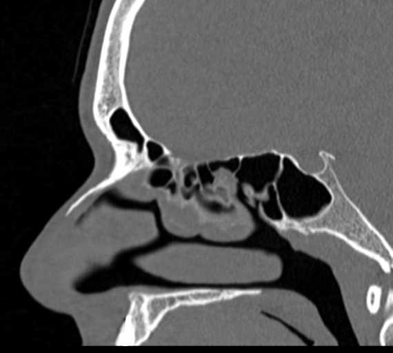Angular epidermoid cyst (Radiopaedia 46908-51439 Sagittal bone window 48).png