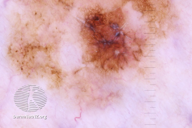 File:Angulated lines seen on dermoscopy of melanoma (DermNet NZ Ssmis-2).jpg