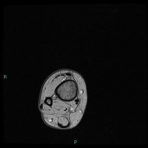 Ankle ganglion cyst (Radiopaedia 62809-71162 Axial Gradient Echo 98).jpg