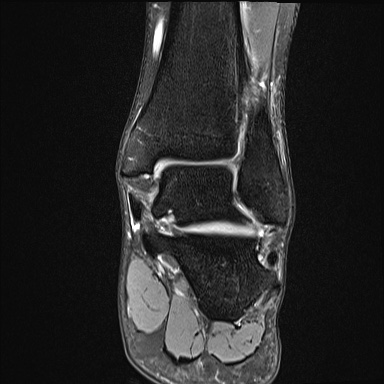 Ankle syndesmotic injury (Radiopaedia 69066-78837 Coronal PD fat sat 28).jpg