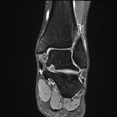 Ankle syndesmotic injury (Radiopaedia 69066-78837 Coronal PD fat sat 29).jpg