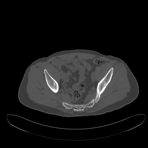 Ankylosing spondylitis (Radiopaedia 52728-58645 Axial bone window 57).jpg