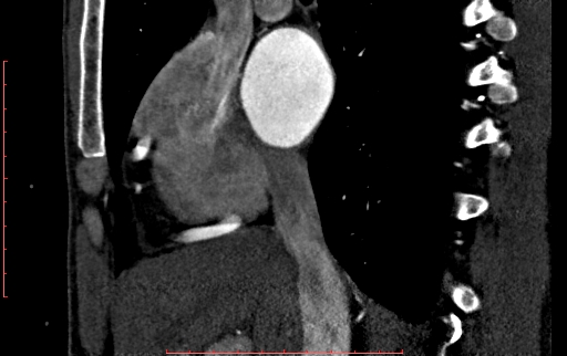 Anomalous left coronary artery from the pulmonary artery (ALCAPA) (Radiopaedia 70148-80181 C 54).jpg