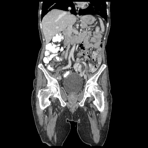 File:Anorectal carcinoma (Radiopaedia 44413-48064 B 39).jpg
