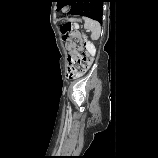 Anorectal carcinoma (Radiopaedia 44413-48064 C 91).jpg