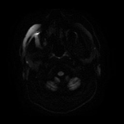 Anterior cerebral artery infarction (Radiopaedia 46794-51323 Axial DWI 3).jpg
