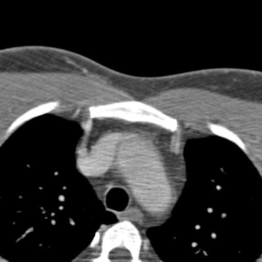 Anterior cerebral artery territory infarct (Radiopaedia 39327-41581 B 112).png