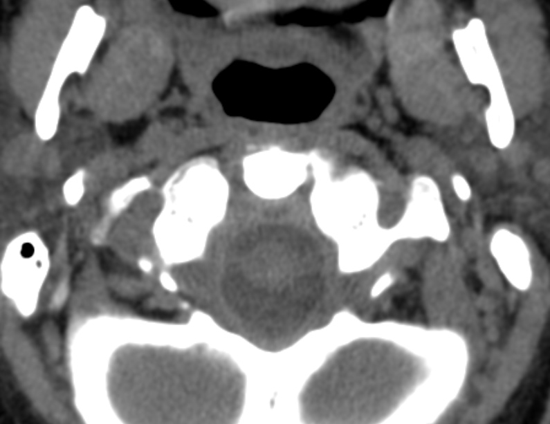 Anterior cervical postdiscectomy arthrodesis (Radiopaedia 32678-33646 Axial non-contrast 13).jpg