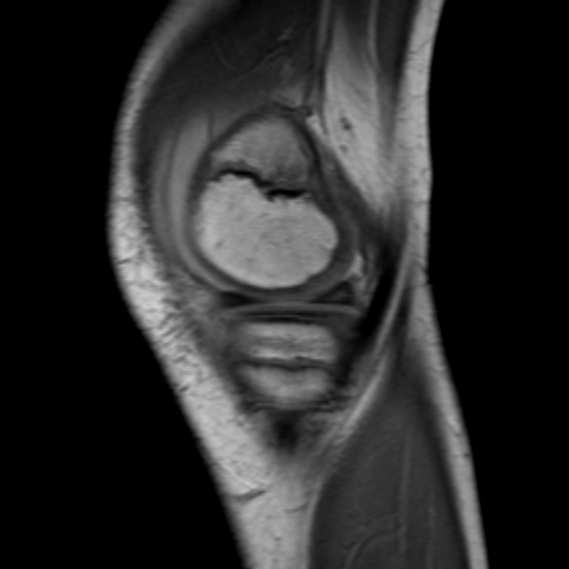 File:Anterior cruciate ligament avulsion fracture (Radiopaedia 24710-24974 Sagittal T1 2).jpg