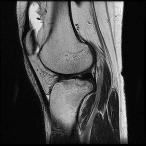 File:Anterior cruciate ligament avulsion fracture (Radiopaedia 58939-66193 Sagittal T2 8).jpg
