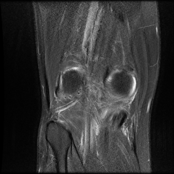File:Anterior cruciate ligament graft tear and bucket-handle tear of medial meniscus (Radiopaedia 75867-87255 Coronal PD fat sat 21).jpg