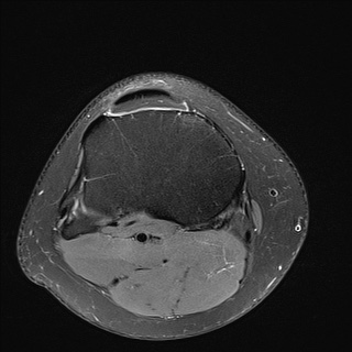File:Anterior cruciate ligament rupture and posteromedial corner injury (Radiopaedia 67338-76723 Axial 26).jpg