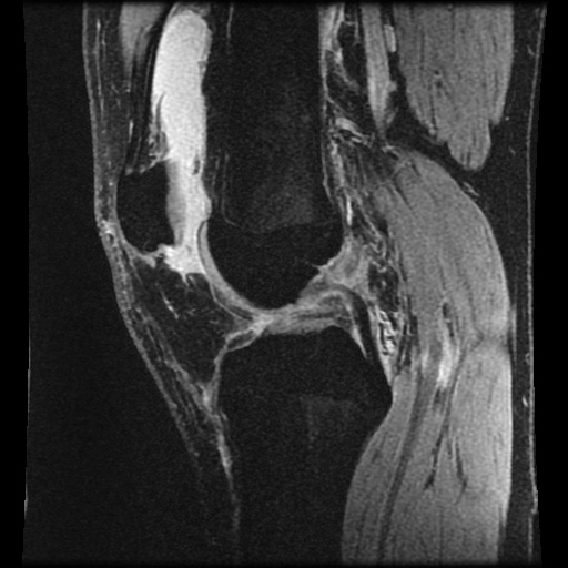 Anterior cruciate ligament tear (Radiopaedia 61500-69462 F 41).jpg