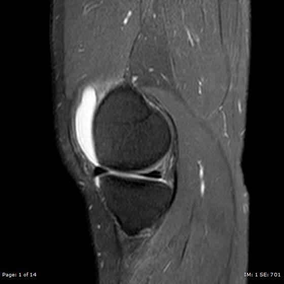File:Anterior cruciate ligament tear (Radiopaedia 70783-80964 Sagittal PD fat sat 1).jpg