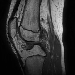 File:Anterior cruciate ligament tear - pediatric (Radiopaedia 62152-70260 Sagittal PD 98).jpg