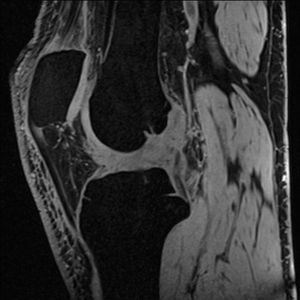 Anterior cruciate ligament tear - ramp lesion (Radiopaedia 71883-82322 Sagittal T1 vibe 74).jpg