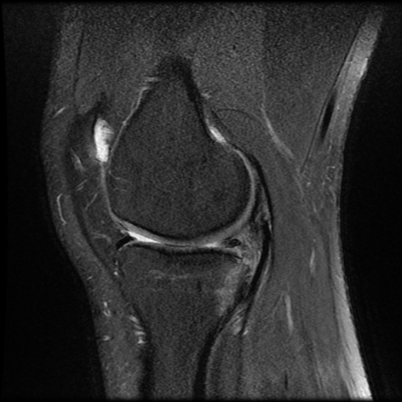 File:Anterior cruciate ligament tear with posteromedial corner injury, bucket-handle meniscal tear and chondral delamination (Radiopaedia 75501-86744 Sagittal PD fat sat 9).jpg