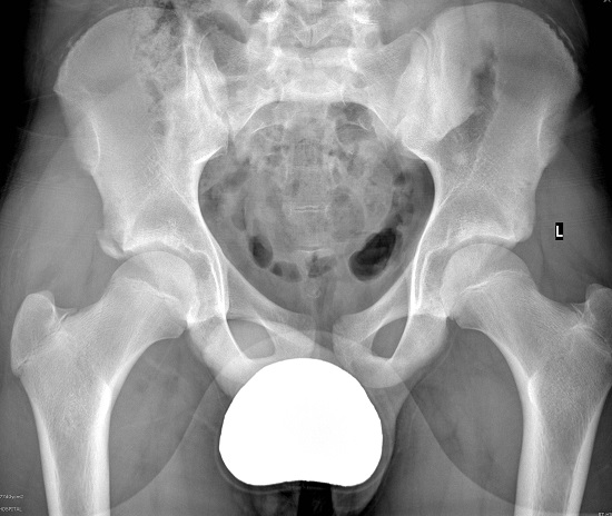 File:Anterior inferior iliac spine avulsion fracture (Radiopaedia 46064).jpg
