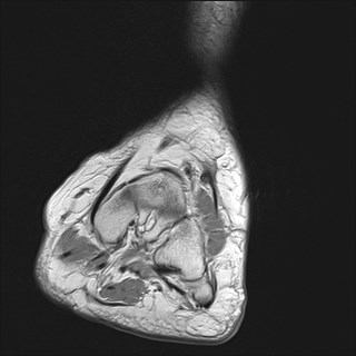 File:Anterior talofibular ligament injury - rupture with soft-tissue impingement (Radiopaedia 38765-40928 Coronal PD 27).jpg