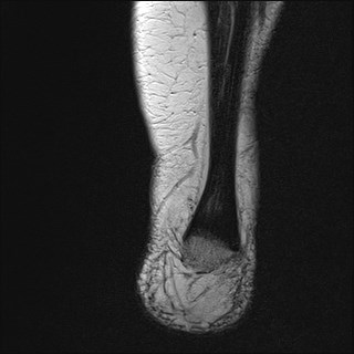 File:Anterior talofibular ligament injury - rupture with soft-tissue impingement (Radiopaedia 38765-40928 Coronal T2 2).jpg