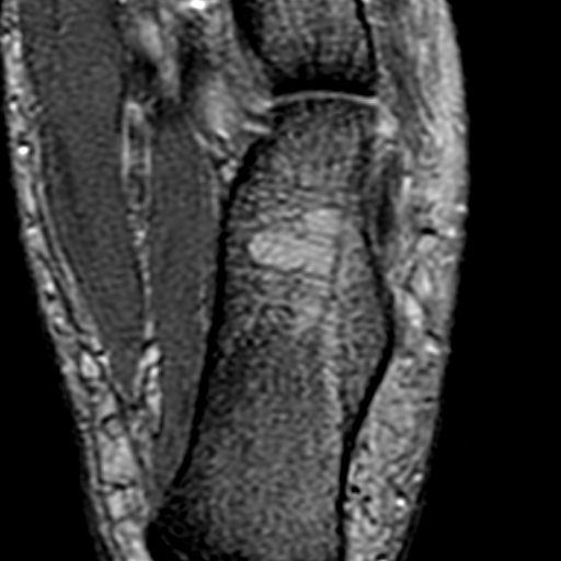 File:Anterior talofibular ligament rupture (Radiopaedia 15831-15484 Axial T2* 21).jpg