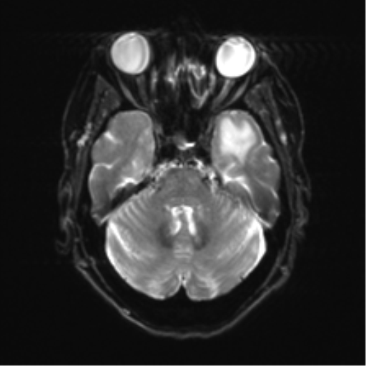 Anterior temporal pole cysts (Radiopaedia 46629-51102 Axial DWI 8).png