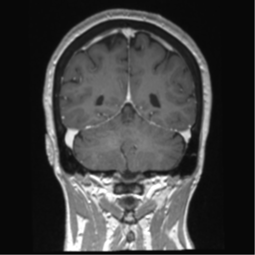 Anterior temporal pole cysts (Radiopaedia 46629-51102 Coronal T1 C+ 49).png